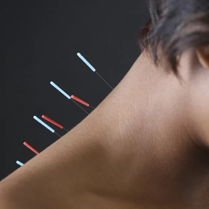 Seirin J-Type no 8 Dry Needling 0,30 x 60 mm