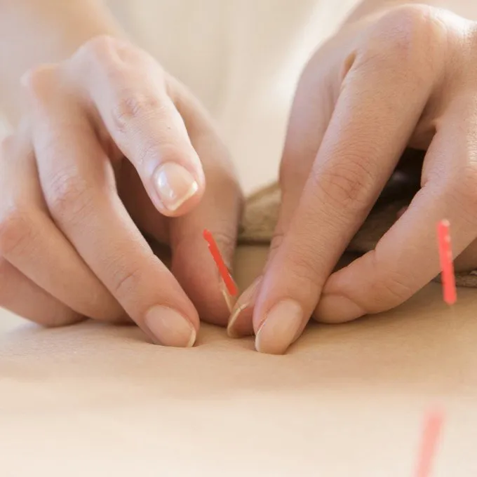 Seirin J-Type no 3 Dry Needling 0,20 x 30 mm